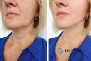 Double chin before and after Hi-Fu treatment 4 Book your double chin treatment Berkshire today! We are here to help!