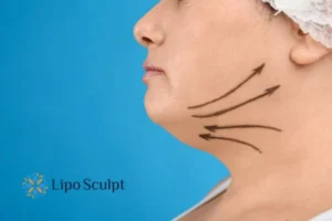Double chin before and after Hi-Fu treatment 3 Boost your confidence with a Double chin treatment Berkshire