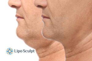 Double chin before and after Hi-Fu treatment 2 Double chin treatment Berkshire from Lipo Sculpt - feel more confident today!