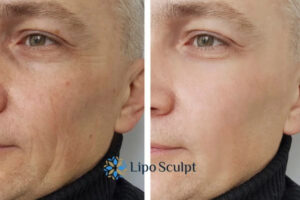 How to Fight Aging Symptoms 3 Fight Aging Symptoms Berkshire With HIFU and Morpheus8 Today!