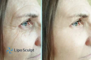 How to Fight Aging Symptoms 2 Do you want to Fight Aging Symptoms Berkshire? Contact Lipo Sculpt today!